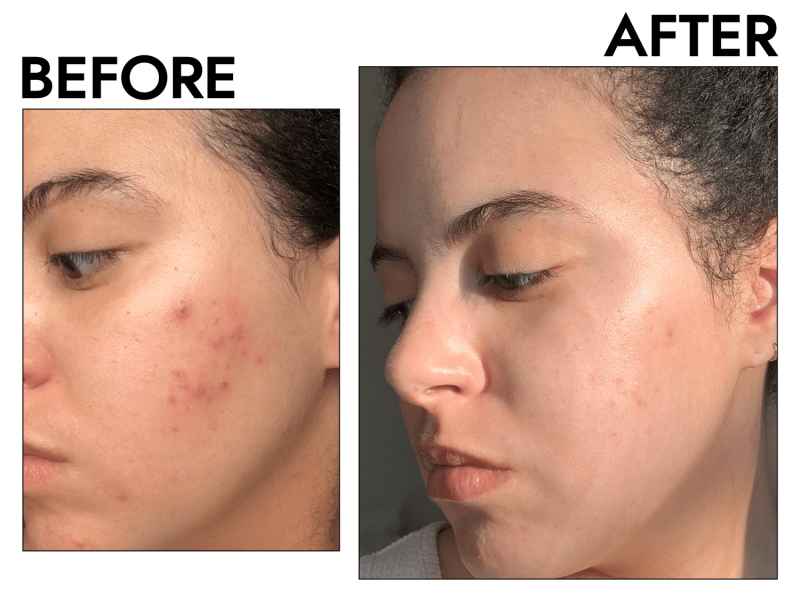 Face Reality—a Referral-Only Skincare Brand—Drastically Improved My Acne